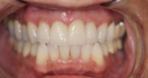 Before & After Photo | Lifestyle Dentistry | Family & General Dentist | Mississauga | Ontario