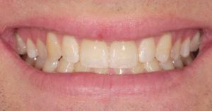 Before & After Photo | Lifestyle Dentistry | Family & General Dentist | Mississauga | Ontario