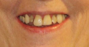 Before & After Photo | Lifestyle Dentistry | Family & General Dentist | Mississauga | Ontario