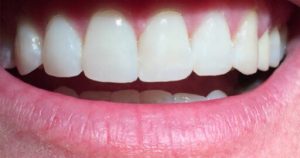 Before & After | Lifestyle Dentistry | Family & General Dentist | Mississauga | Ontario