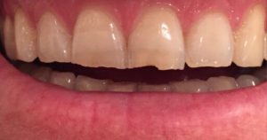 Before & After Photo | Lifestyle Dentistry | Family & General Dentist | Mississauga | Ontario