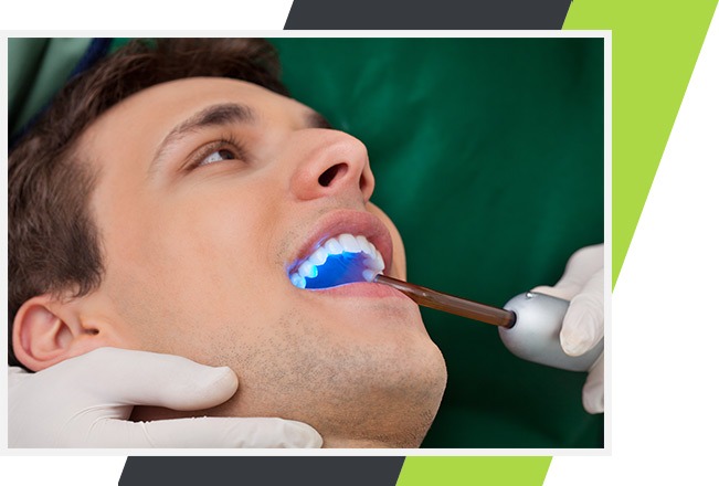 Dental Bonding | Lifestyle Dentistry | Family & General Dentist | Mississauga | Ontario