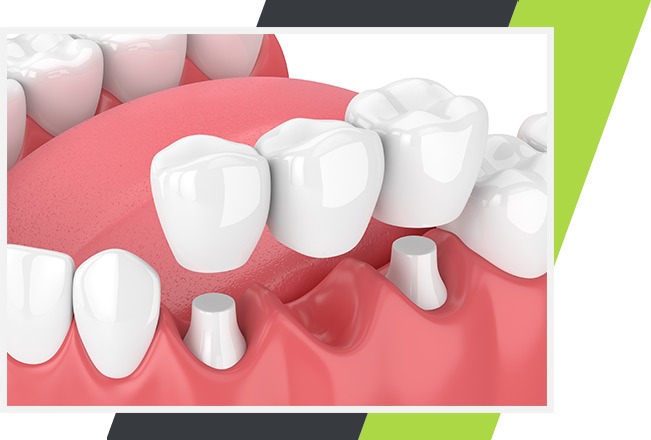 Dental Bridges | Lifestyle Dentistry | Family & General Dentist | Mississauga | Ontario