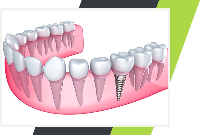 Dental Implants | Lifestyle Dentistry | Family & General Dentist | Mississauga | Ontario