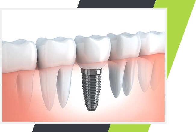 Dental Implants in Mississauga | Lifestyle Dentistry | Family & General Dentist Ontario