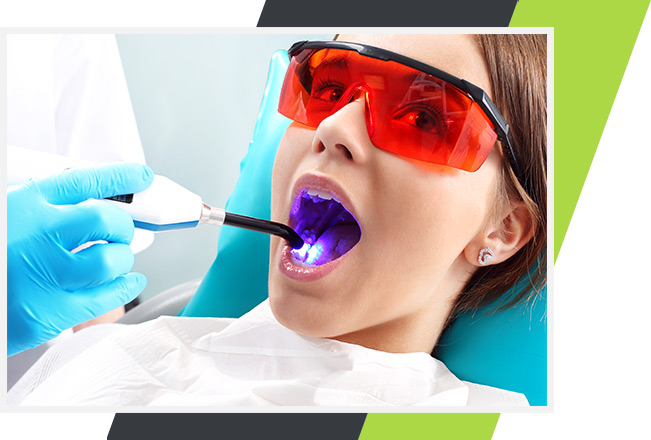 Dental Sealants | Lifestyle Dentistry | Family & General Dentist | Mississauga | Ontario