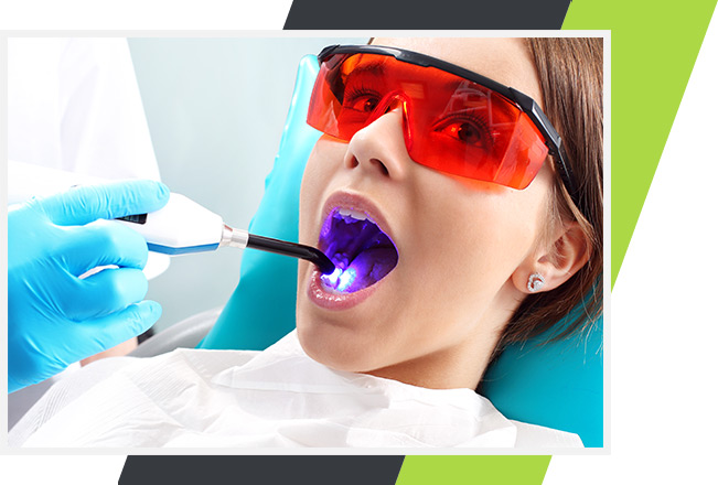 Dental Sealants Mississauga Dentist | Lifestyle Dentistry | Family & General Dentist