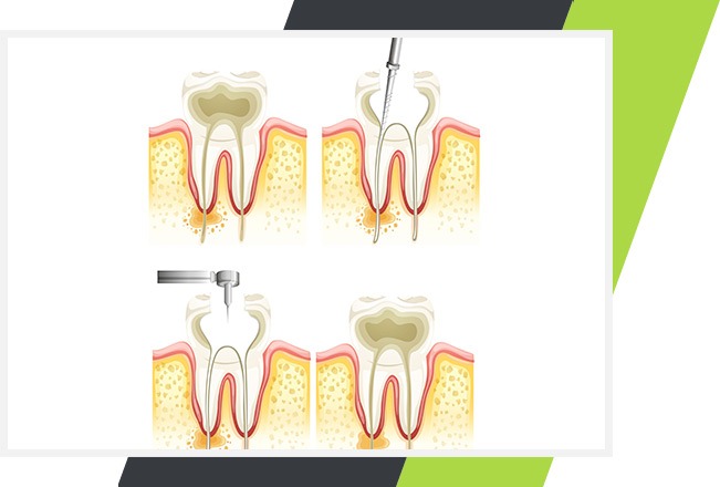 Mississauga Root Canal Therapy | Lifestyle Dentistry | Family & General Dentist Mississauga