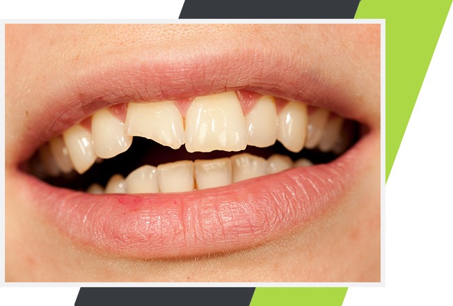 Endodontic Treatment | Lifestyle Dentistry | Family & General Dentist | Mississauga | Ontario
