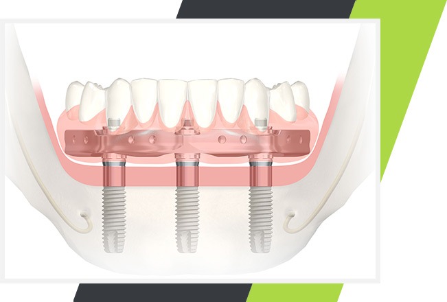 Mississauga Implant Retained Dentures | Lifestyle Dentistry | Family & General Dentist Mississauga, ON