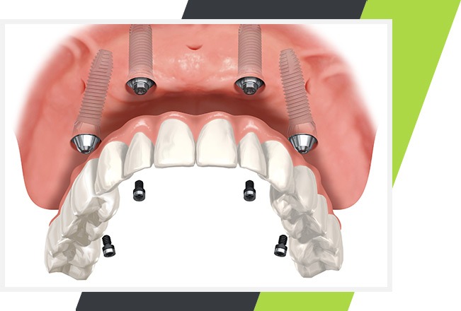 Implant Supported Dentures | Lifestyle Dentistry | Family & General Dentist | Mississauga | Ontario