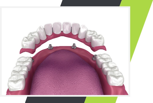 Implant Supported Partials | Lifestyle Dentistry | Family & General Dentist | Mississauga | Ontario