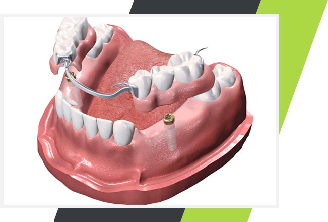 Implant Supported Partials | Lifestyle Dentistry | Family & General Dentist | Mississauga | Ontario