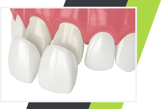 Porcelain Veneers | Lifestyle Dentistry | Family & General Dentist | Mississauga | Ontario