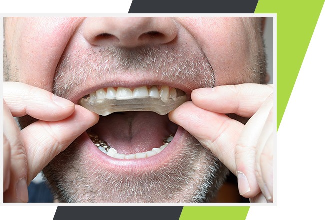 Mississauga Preventative Dentistry | Occlusal Night Guards | Lifestyle Dentistry Ontario