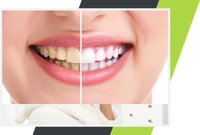Teeth Whitening | Lifestyle Dentistry | Family & General Dentist | Mississauga | Ontario
