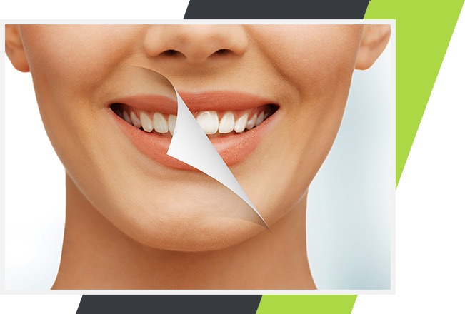 Teeth Whitening | Lifestyle Dentistry | Family & General Dentist | Mississauga | Ontario