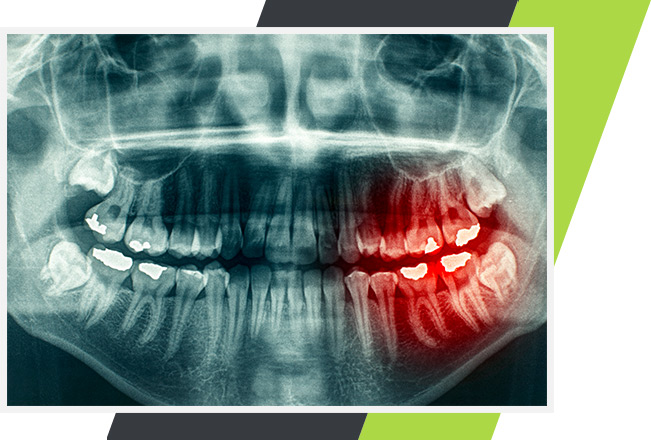Wisdom Teeth Extractions | Lifestyle Dentistry | Family & General Dentist | Mississauga | Ontario